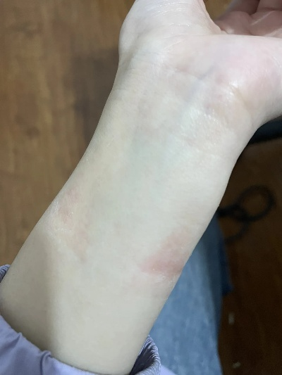 欧米茄手表戴着过敏 如何避免手表过敏问题 表带 过敏 手表 手表资讯  第1张