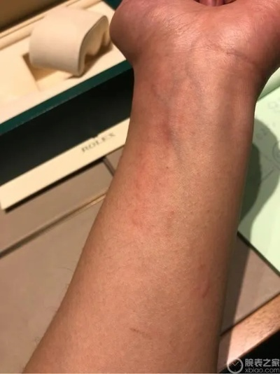 欧米茄手表过敏怎么办 应对手表过敏问题的方法 手腕 过敏 症状 药膏 手表资讯  第1张